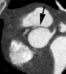 たかはし Coronary Artery Calcification and Coronary CTA: | AuntMinnie